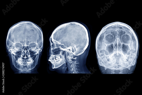  Skull x-ray image of Human skull  AP, Lateral and water view for demonstrate facial bone isolated on Black Background.