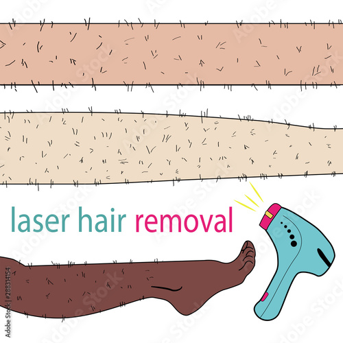 Sketch drawn in vector: woman removes hair from hairy legs with laser hair removal, shaving, waxing, shugaring on an isolated background