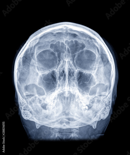  Skull x-ray image of Human skull  water view for demonstrate facial bone isolated on Black Background.