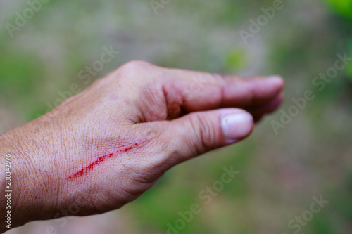 Fresh wounds with blood,Closeup view of Knife man's hand cut,hand with blood © CStock