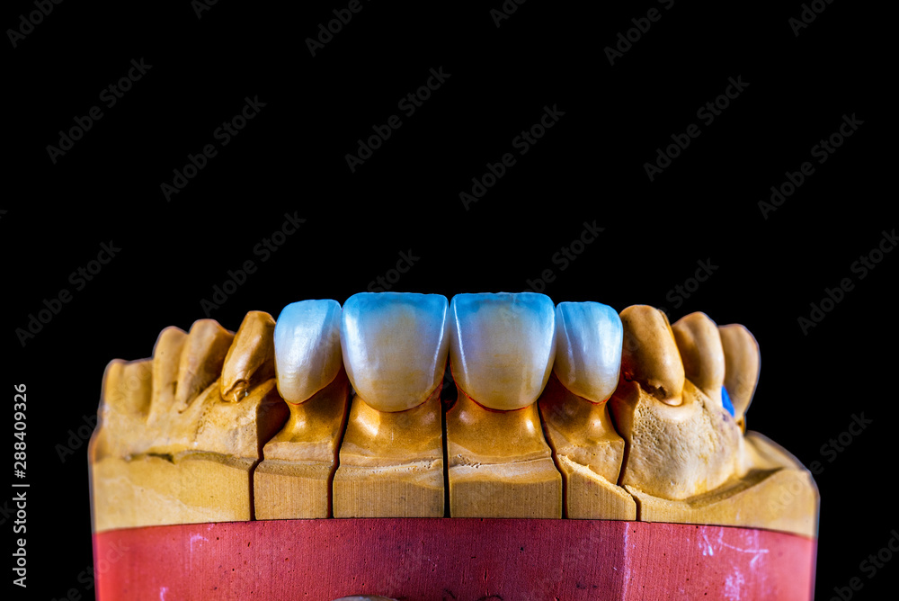 4 units natural color press ceramic veneers 4 units natural color press ceramic veneers