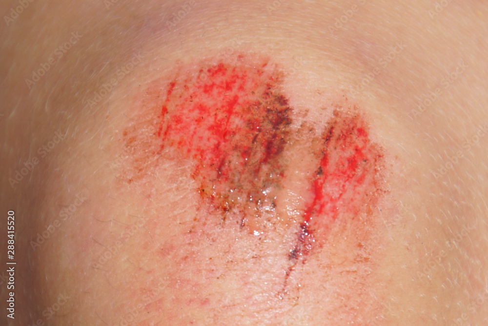 Fototapeta premium Close up of a partly infected knee wound.