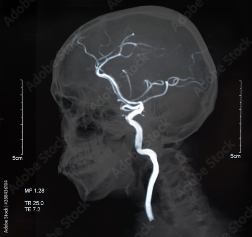 mri blood vessels photo