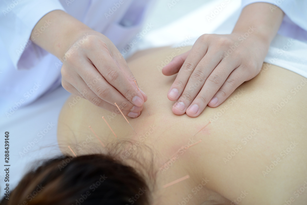 Closeup of hand performing acupuncture therapy on patient's back at chinese alternative medicine clinic Closeup of hand performing acupuncture therapy on patient's back at chinese alternative medicine clinic