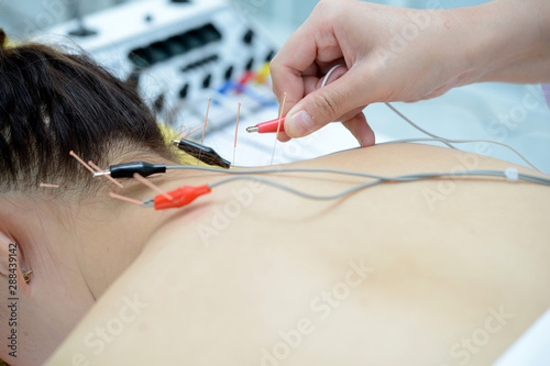 Electro-Acupuncture.Traditional Chinese acupuncture and Electroacupuncture on body of patient