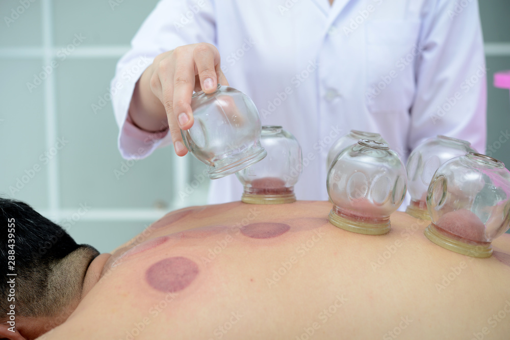 A Person Receiving Cupping Treatment On Back In Spa,Traditional Chinese Medicine Treatment. A Person Receiving Cupping Treatment On Back In Spa,Traditional Chinese Medicine Treatment.