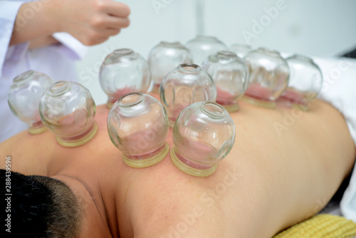 A Person Receiving Cupping Treatment On Back In Spa,Traditional Chinese Medicine Treatment.