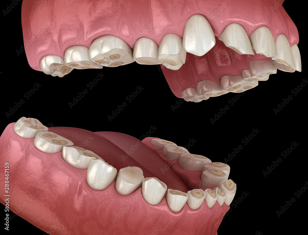 Dental attrition (Bruxism) resulting in loss of tooth tissue.  Medically accurate tooth 3D illustration - obrazy, fototapety, plakaty 