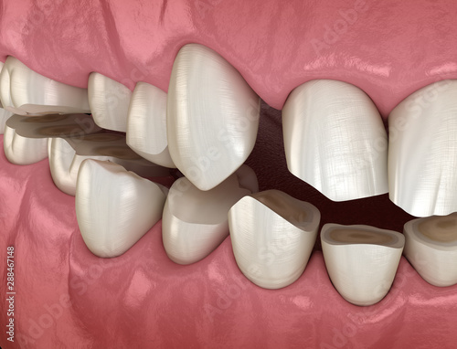 Dental attrition (Bruxism) resulting in loss of tooth tissue.  Medically accurate tooth 3D illustration photo