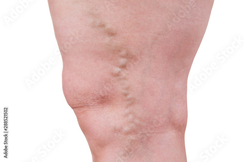 Varicose veins closeup, fat female legs isolated on white background