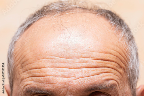 Fotografie, Obraz A closeup view on the lines and wrinkles in the forehead of an older man in his fifties, natural aging of the human body with receding grey hair