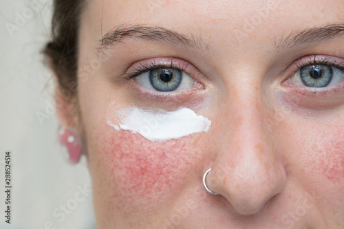 A closeup view of a pretty caucasian girl with topical cream below the eye, over red blotchy cheek, topical ivermectin and azelaic acid cream treat rosy cheeks.