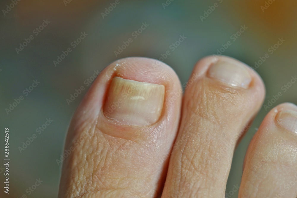 foot with nail psoriasis. A woman has an ingrown toenail. short cutted