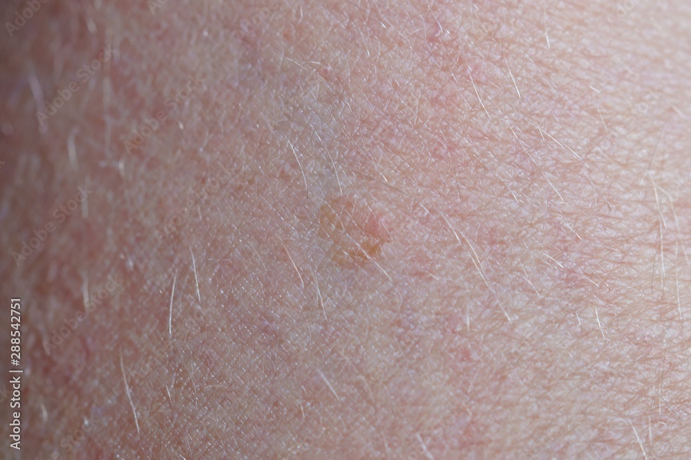 Basal cell carcinoma, benign skin cancer, basal-cell cancer on human skin, keratinizing squamous cell carcinoma of the skin. no healthy epidermis. cancer at the beginning 