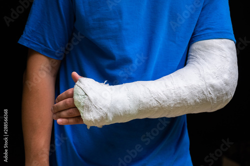 Quadro em tela Man with broken arm wrapped medical cast plaster