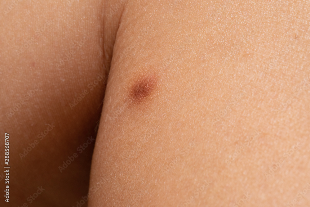 An extreme closeup view of a birthmark on the skin of a person, brown patch of skin since birth on human, dermatology concept. An extreme closeup view of a birthmark on the skin of a person, brown patch of skin since birth on human, dermatology concept.