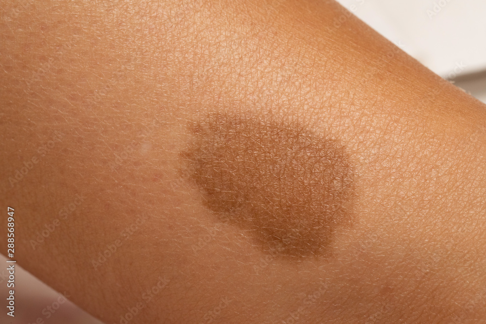 A closeup view of a large brown birthmark on the leg of a person, normally harmless and benign skin pigmentation can cause anxiety of appearance. A closeup view of a large brown birthmark on the leg of a person, normally harmless and benign skin pigmentation can cause anxiety of appearance.