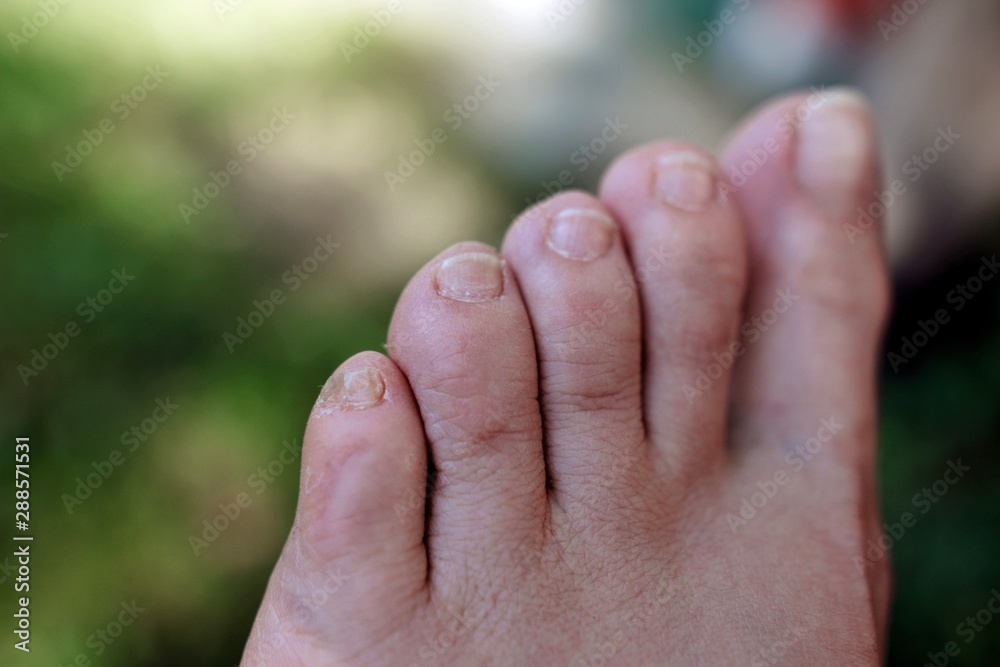 Split nail on a toe close up on a blurry background. Little toenail is deformed and looks disgusting Split nail on a toe close up on a blurry background. Little toenail is deformed and looks disgusting