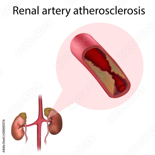 Renal artery atherosclerosis. Vector medical anatomy illustration.