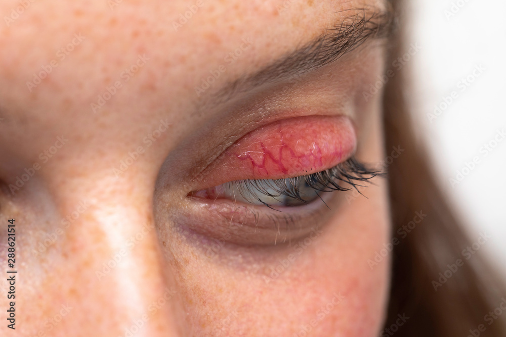 An extreme closeup view on the eye of a young caucasian woman suffering from a stye of the upper eyelid, bacterial infection caused by staphylococcus aureus.