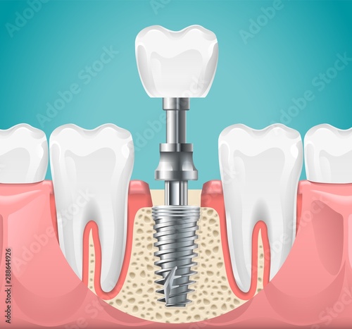 Dental surgery. Tooth implant cut vector illustration. Healthy teeth and dental implant, stomatology poster. Implant dental metal screw in gum photo