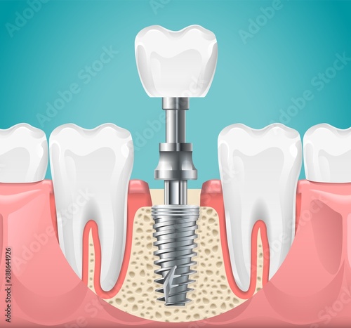 Dental surgery. Tooth implant cut vector illustration. Healthy teeth and dental implant, stomatology poster. Implant dental metal screw in gum