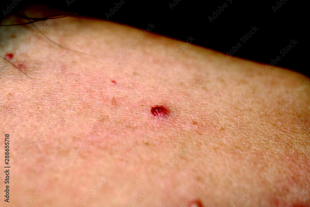 Torn off a bleeding pimple on the skin. Inflammation, acne. Stock Photo