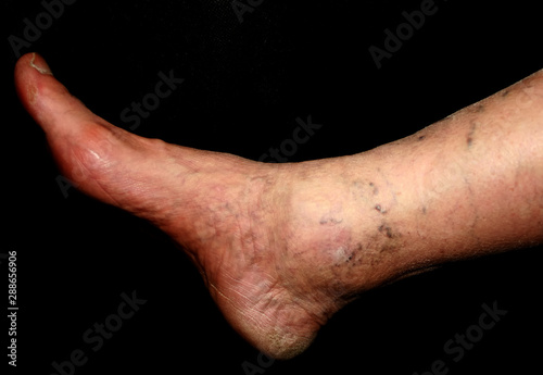 Leg. Varicose veins. Phlebeurysm. Thrombophlebitis. leg in veins.