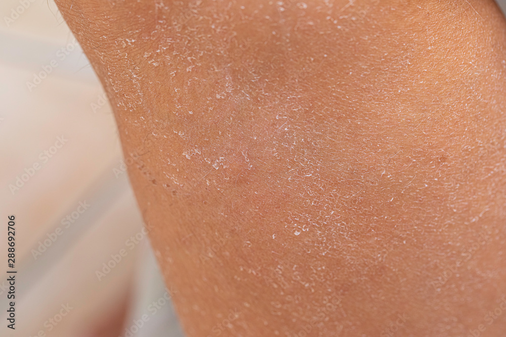 Fototapeta premium An extreme close up view if dry and shedding caucasian skin, dead and peeling away from the human body, regeneration of new flesh.