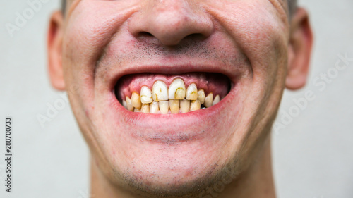 Bad man teeth. Low-quality cavity fillings.