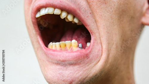 Teeth implantation. Dental post preparation. Medical problem.