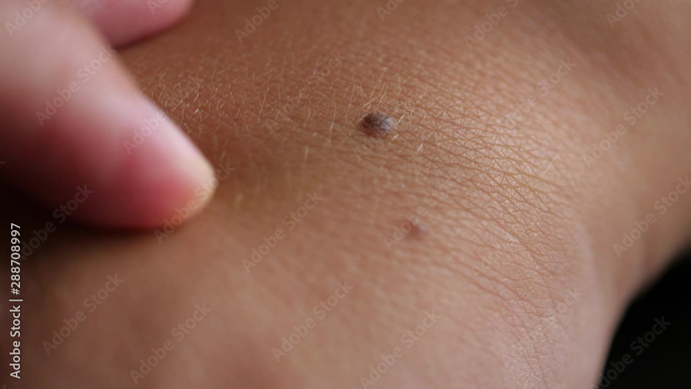 skin examination  Detail of brown skin mole on caucasian skin, finger moving on skin. High definition