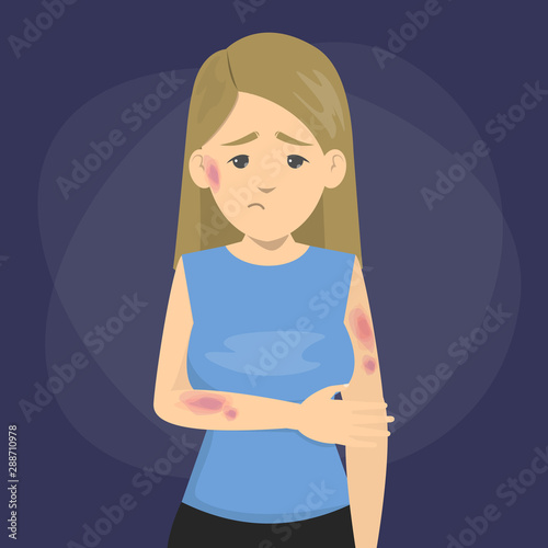 Woman with bruises on the skin. Health injury