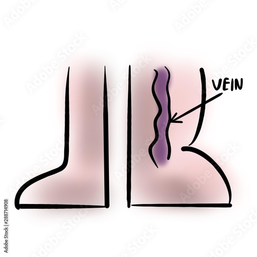 Varicose vein and leg swelling