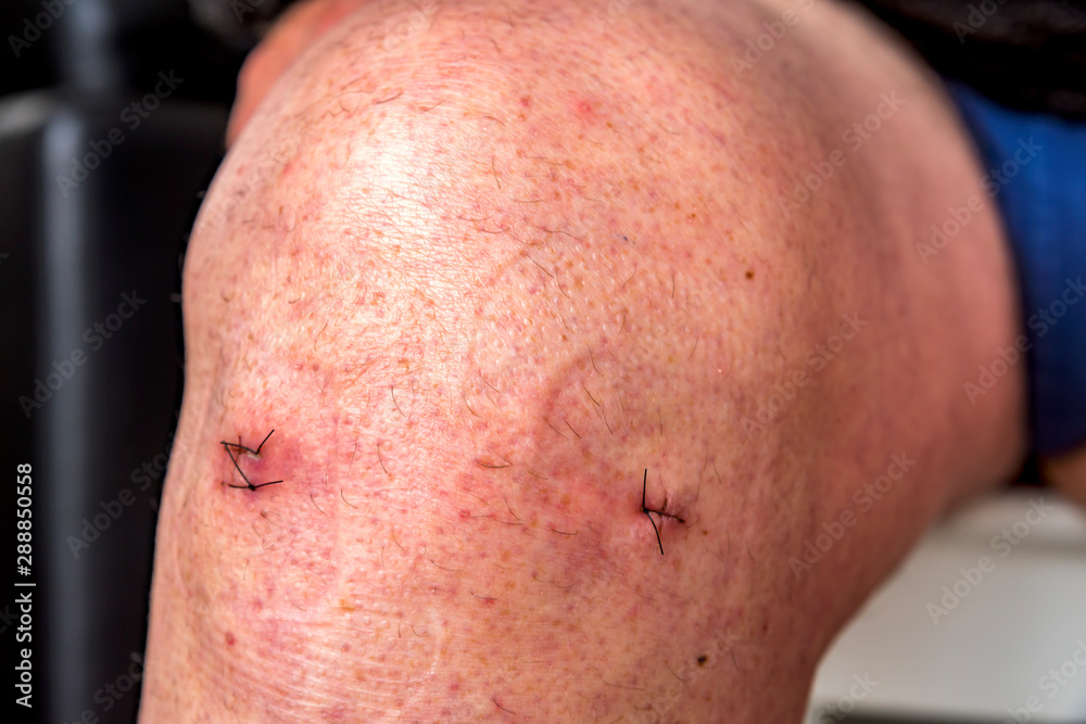 Points de suture sur un genou Points de suture sur un genou