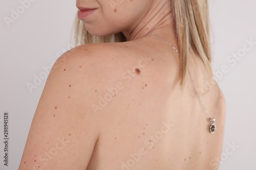 Woman with birthmark on her back, skin. Checking benign moles. Skin tags removal
