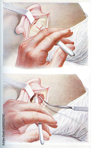 Surgery and medicine - trepanation of the mastoid process, the bony prominence behind the earlobe photo