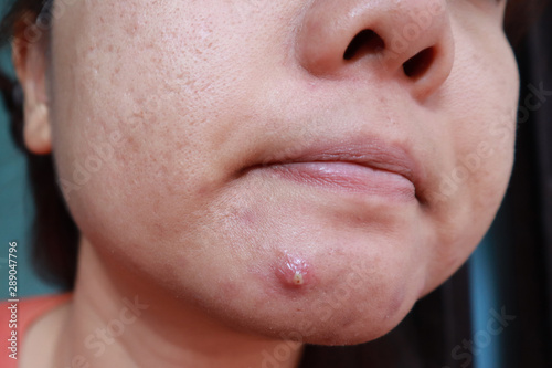 Woman squeezing pimple with dirty bare hands, Removing pustules whitehead acne from face, Problems with acne and scar on the female skin. photo