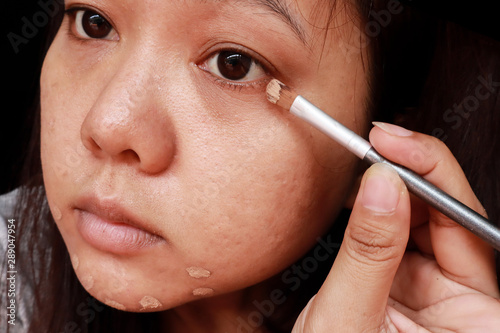 Acne skin problem,Closeup of Asian woman applying concealer makeup to under the eyes, face make up covered, skin concept