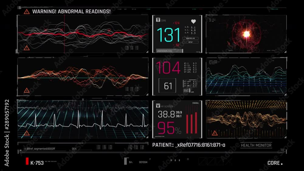 Patient's death, ICU monitor with dropping vital signs, heart attack, failure. Medicine, health care, critical care