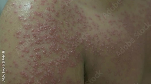 Tenggarong, Indonesia, 2019 July 29th, Close up of patient who is having varicella or chickenpox disease in hospital