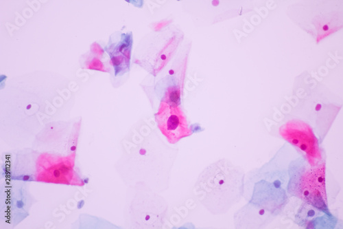 View in microscopic of abnormal human cervix cells.Koilocyte cell criteria of Human Papilloma Virus (HPV) infection from pap smear slide.Cytology and pathology laboratory department.Magnification 400X