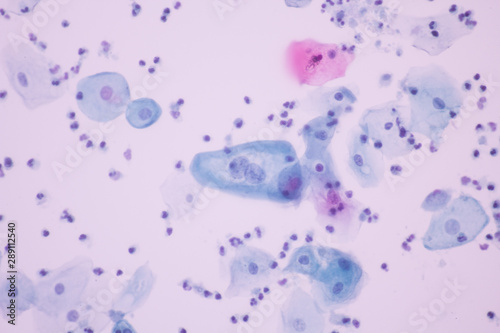 View in microscopic of abnormal human cervix cells.Koilocyte cell criteria of Human Papilloma Virus (HPV) infection from pap smear slide.Cytology and pathology laboratory department.Magnification 400X photo