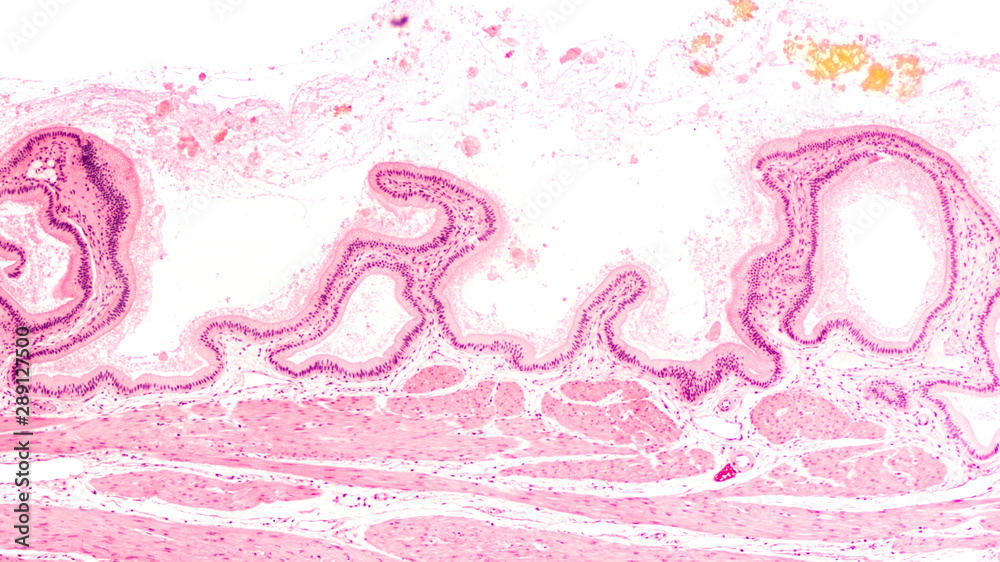 Cross section of a human gallbladder, from a patient with gallstones