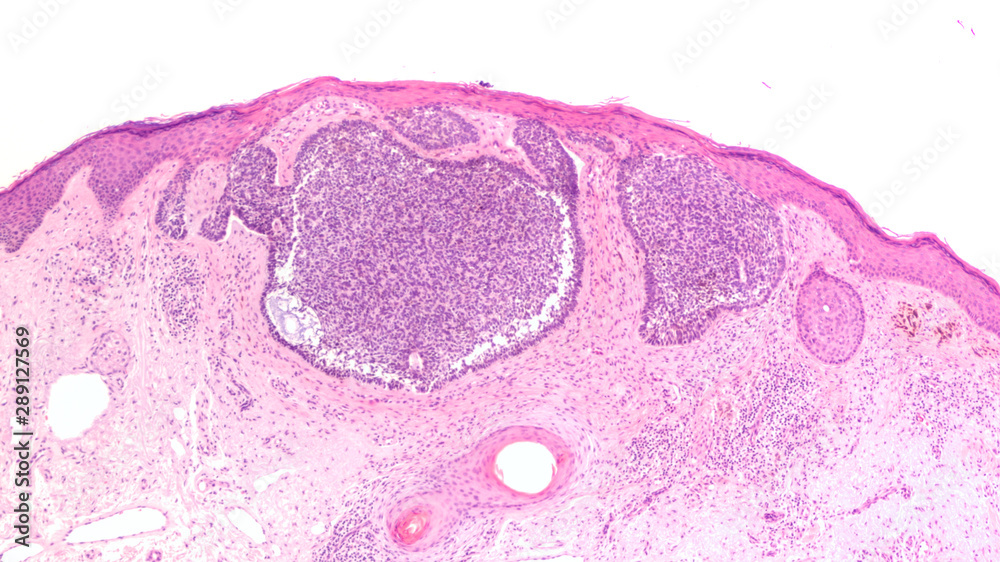 Fototapeta Skin biopsy pathology of basal cell carcinoma, the most most common type of sun