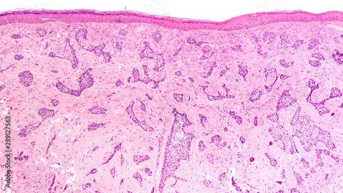 Photomicrograph of skin biopsy showing a sclerosing (morpheaform) basal cell carcinoma. photo