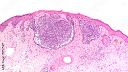 Skin biopsy pathology of basal cell carcinoma, the most most common type of sun induced skin cancer, invading the dermis.  Regular use of sunscreen can be preventative.