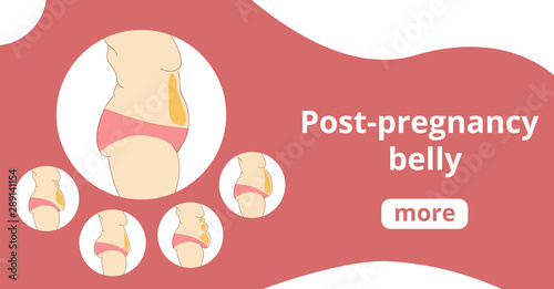 Types of female tummies banner. Tummy tuck surgery or abdominoplasty vector illustration. Medical advertising of cosmetic plastic procedures.