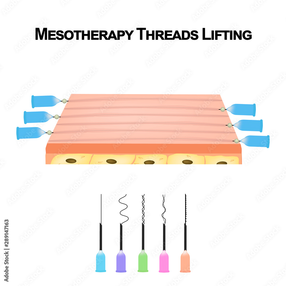 Mesotherapy Threads Lifting. Different types of threads for facelift ...