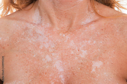 Fotografie detail of vitiligo spots on the skin